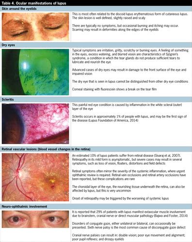 Ocular Involvement In Systemic Lupus Erythematosus Implications For