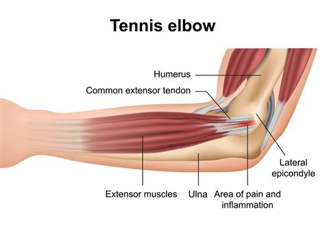 Elbow Injury Torn Tendons Tendonitis Repair Atelier Yuwa Ciao Jp