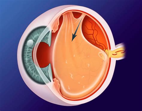 Posterior Vitreous Detachment American Academy Of Ophthalmology