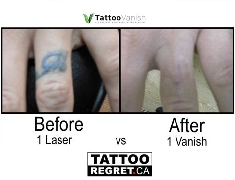 Tattoo Removal Before And After ️ Save 197 Tattooregretca