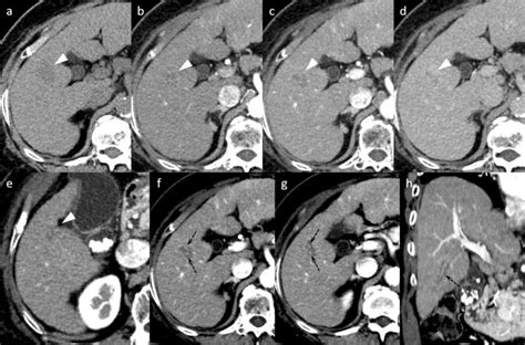 Computed Tomography Ct Images On Noncontrast Ct The Liver Showed A