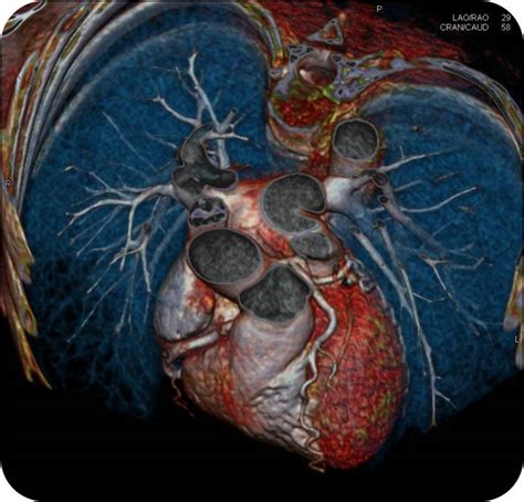 Como Se Genera La Enfermedad Coronaria Cardioactivo