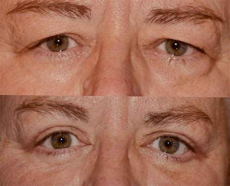 Cosmetic Eyelid Surgery How To Manage Your Expectations