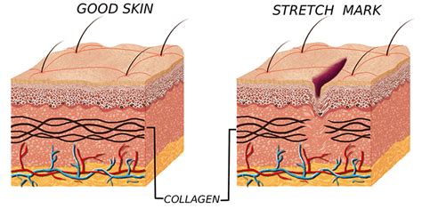 Microdermabrasion To Remove Stretch Marks Skinbase™
