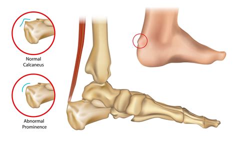 Haglunds Deformity Milton Orthotic Wellness Centre