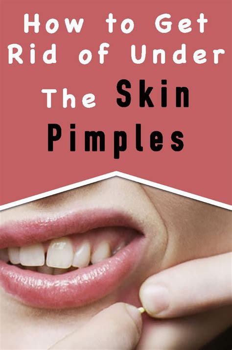 How To Get Rid Of Under Skin Pimples Blind Pimple Pimples How To
