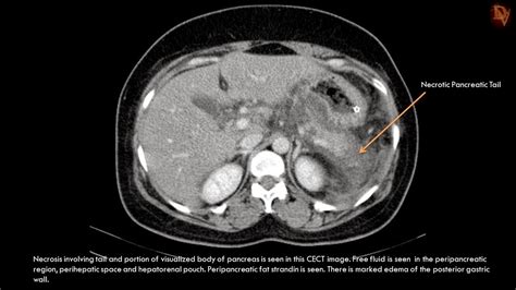 Ultimate Radiology Acute Necrotizing Pancreatitis