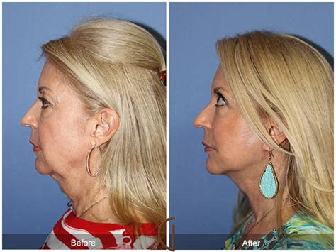 Neck Lift Before And After Photos Patient 14 Dr Kevin Sadati