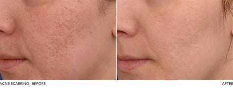 Adult Acne And Scarring Aesthetic Skin Clinic Burnley Lancashire