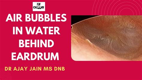 Air Bubbles In Water Seen Behind The Eardrum Otitis Media With