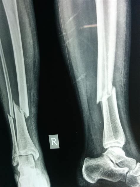 Distal Third Tibia Fracture