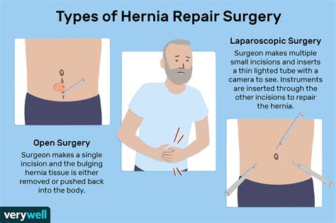 Hernia Repair Surgery Overview