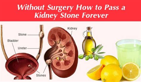 Without Surgery How To Pass A Kidney Stone Forever In 24 Hours 100