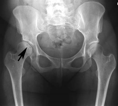 Avascular necrosis can be caused by disease or by severe trauma, such as a fracture or decompression sickness, also know as divers' disease, the bends, or caisson disease, from a lot of deep sea diving. A case of Femoral Head Avascular Necrosis