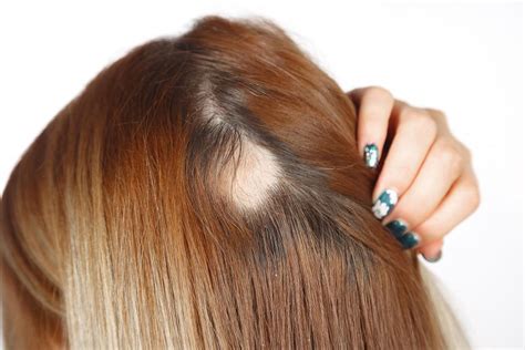 Myths And Facts About Alopecia Northstar Dermatology Dermatology