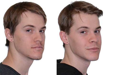 Orthognathic Surgery With Bone Grafting Corrective Jaw Surgery Dr