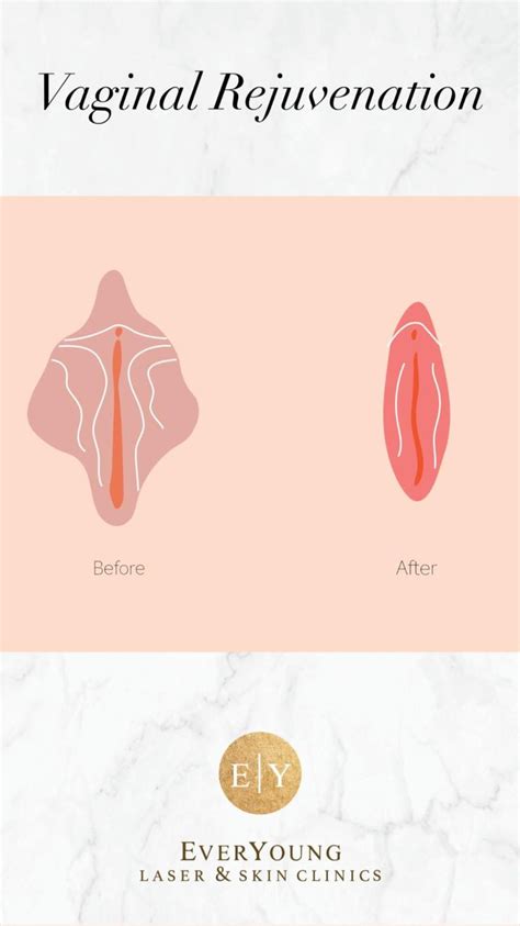 Vaginal Rejuvenation Skin Care Anti Aging Before And After