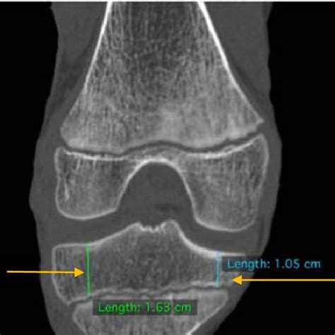 The Medial Tibial Plateau Posterior Slope Plotted Against Age