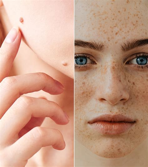 freckle vs mole what s the difference and is it dangerous