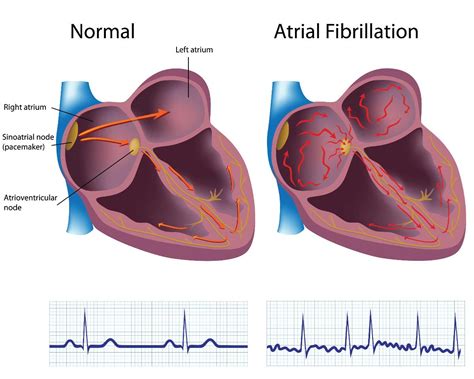 Atrial Fibrillation The Heart And Diving Dan Health And Diving