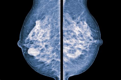 Mammograms And Breast Examination Md Anderson Cancer Center