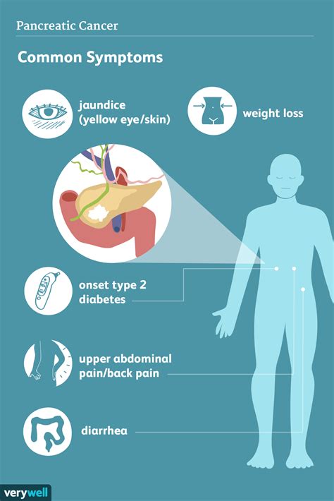 Pancreatic cancer is the 11th most common cancer in the uk. Pancreatic Cancer: Signs, Symptoms, and Complications