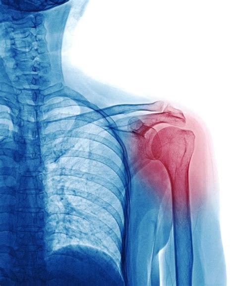 Shoulder Pain Symptoms Elite Pain And Health Oklahoma Joint Doctors