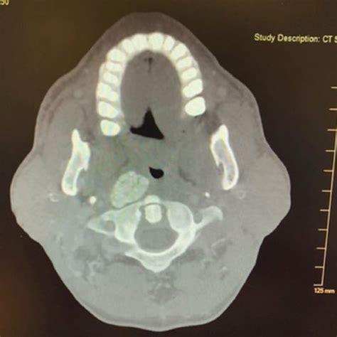 Mri Soft Tissue Neck Large Right‐sided Parapharyngeal Mass Download