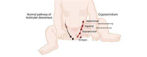 The Different Locations Of A Cryptorchid Testis Illustration Of Normal Download Scientific