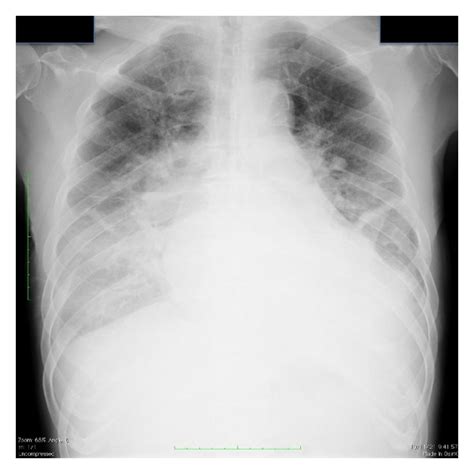 Chest X Ray At Admission Significant Pulmonary Congestion And Reduced