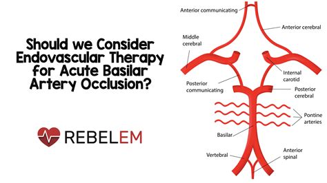 Should We Consider Endovascular Therapy For Acute Basilar Artery Occlu