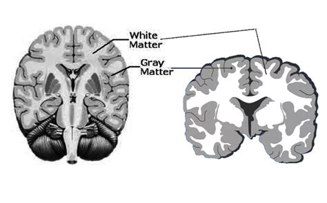 Figure Gray And White Matter Image Courtesy S Bhimji Md