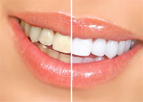 Your Cosmetic Dentist In Denton Says Its Time For A Smile Revamp