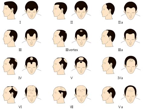 Here are 17 hair loss treatments you can talk to your doctor. Hair Loss In Women & Men - Causes, Diagnosis & Hair Loss ...