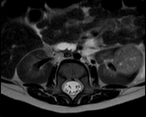 Cervical Malignant Extrarenal Rhabdoid Tumor Eurorad