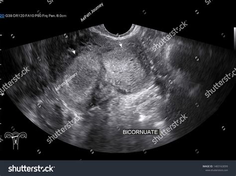 Transvaginal Ultrasound Uterus Bicornuate Uterus Transverse Foto Stok