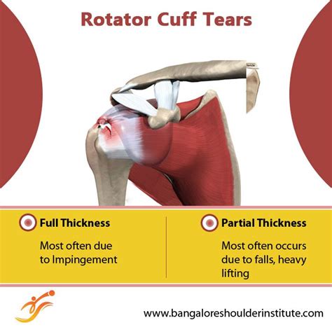 To Know About The Causes Symptoms And Treatment Options For Rotator