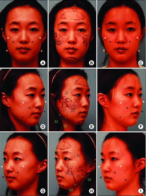 A 27 Year Old Female With An Asymmetrical Face Due To Smaller And