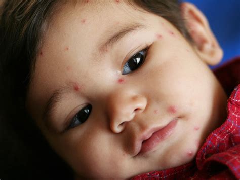 Viral Infection In Babies Babycenter India