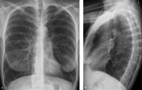 Lung And Pleura Radiology Key