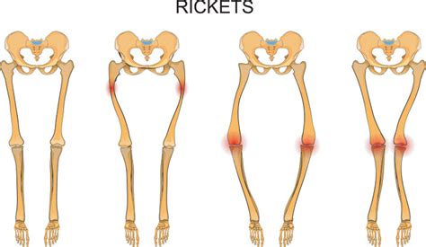 Fda Approves New Drug For Rare Form Of Rickets American Nurse Today