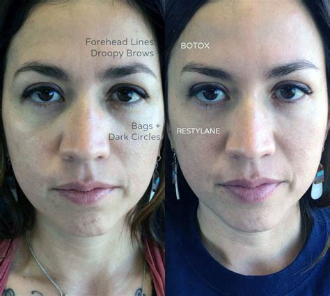 Eyebrow Lift Using Botox Eyelid Surgery Cost Photos