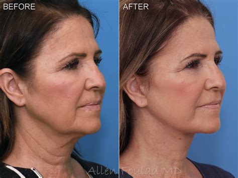 Facelift Beverly Hills Neck Lift Los Angeles
