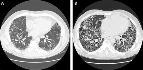 Challenges In Pulmonary Fibrosis · 3 Cystic Lung Disease Thorax