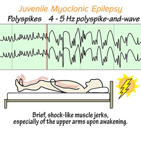 Juvenile Myoclonic Epilepsy Medizzy