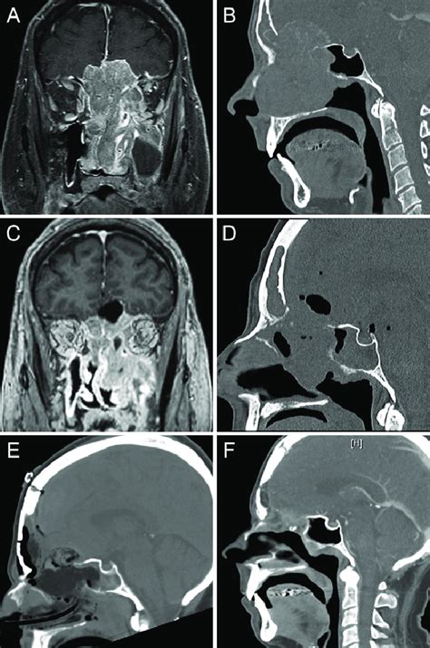 Preoperative Coronal Contrast Enhanced T1 Weighted Mri A And Sagittal
