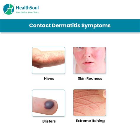 Contact Dermatitis Causes Diagnosis And Treatment Dermatology