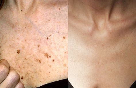 Skin Spots Treatment Before And After Your Magazine Lite