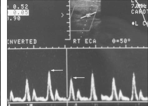 Figure 10 From A Spectrum Of Doppler Waveforms In The Carotid And