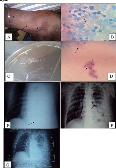 Figure 1 From Disseminated Nocardia Otitidiscaviarum Infection In An